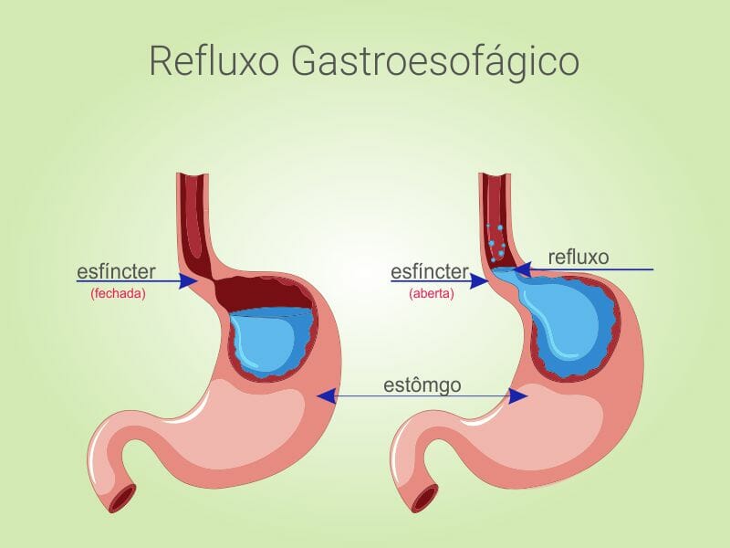 ilustração do estômago demonstrando o refluxo gastroesofágico